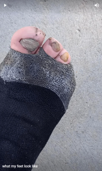 File:TrenchFoot.png